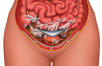 Prior C Section Can Cause Adhesions