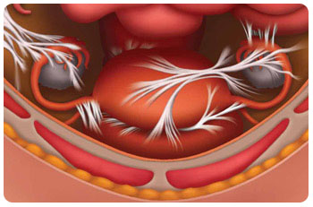 How to Tell if You Have Adhesions After C-Section ( C-Section Scar