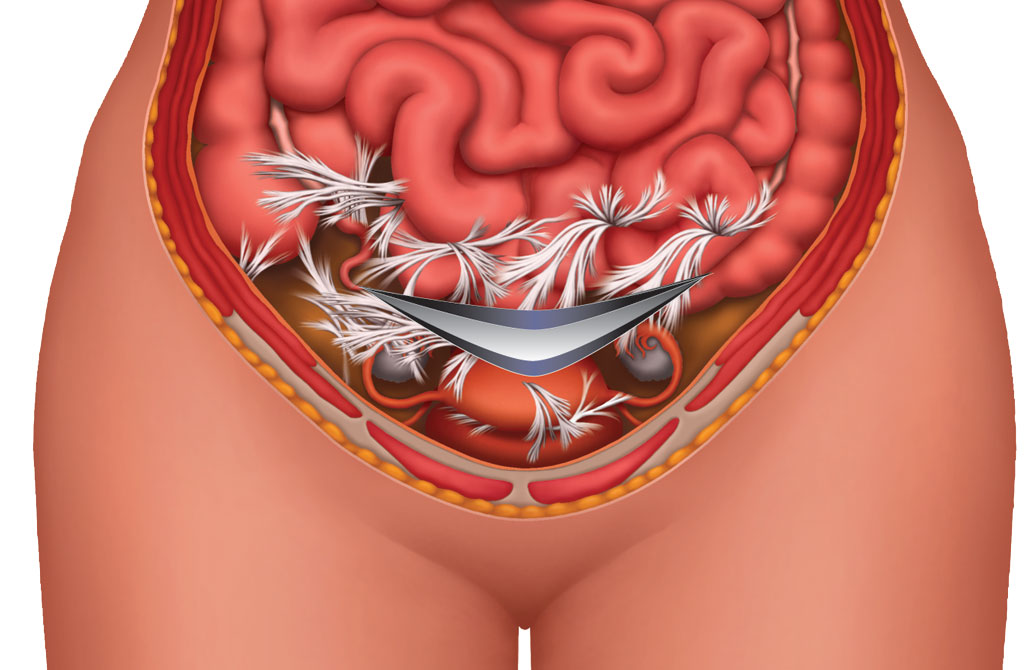 Study Points to Link Between C Section and Adhesions