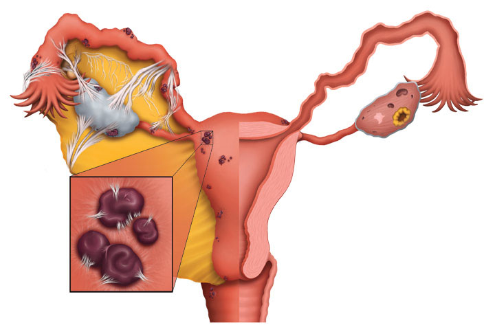 Endometriosis Staging - The Four Stages of Endometriosis - Clear