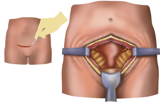 laparoscopic hysterectomy scars