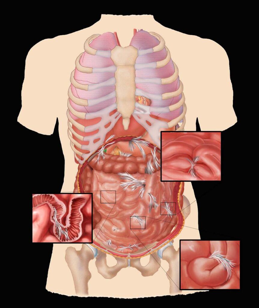An image of the side effects of abdominal surgery.