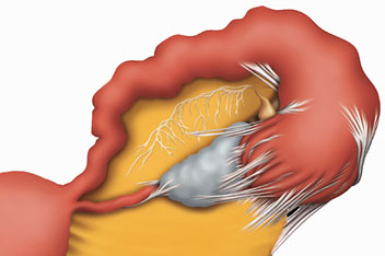 image showing fallopian tube blocked by adhesions