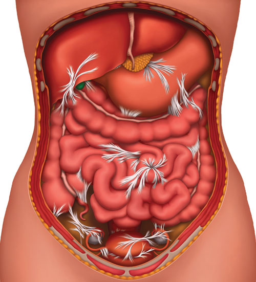 small bowel obstruction