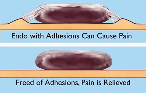 An image of Endo with adhesions which can cause pain.