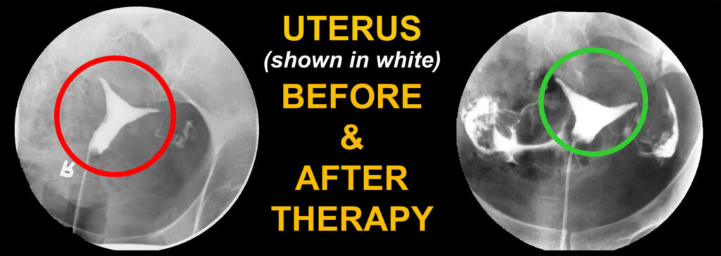 Uterus (shown in white) Before & After Therapy
