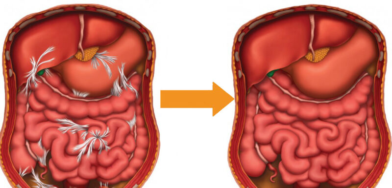 Abdominal and Pelvic Adhesions: Post-surgical Adhesions - Clear