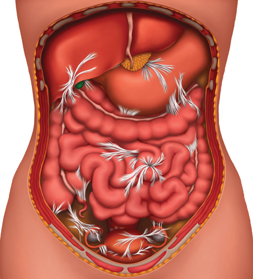 An Image of how adhesions affect SIBO (small intestine bowel obstruction).