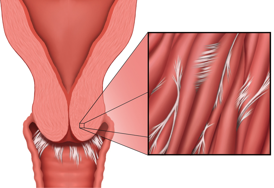 What is scar tissue & how can I help you