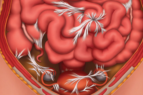 An image of adhesions that cause small intestinal bowel obstruction.