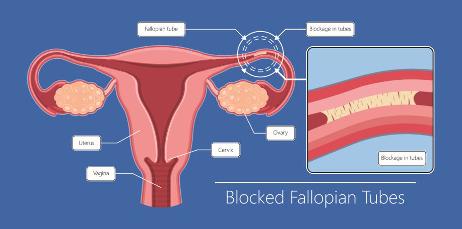 Non Surgical Miracle A Breakthrough in Treating Blocked Fallopian