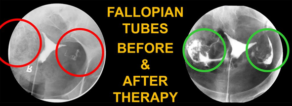 Fallopian Tubes Before & After Therapy