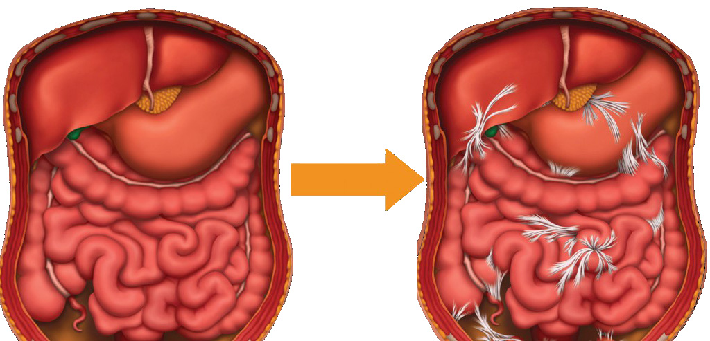 An image of stomach adhesions in abdomen that cause in patents.