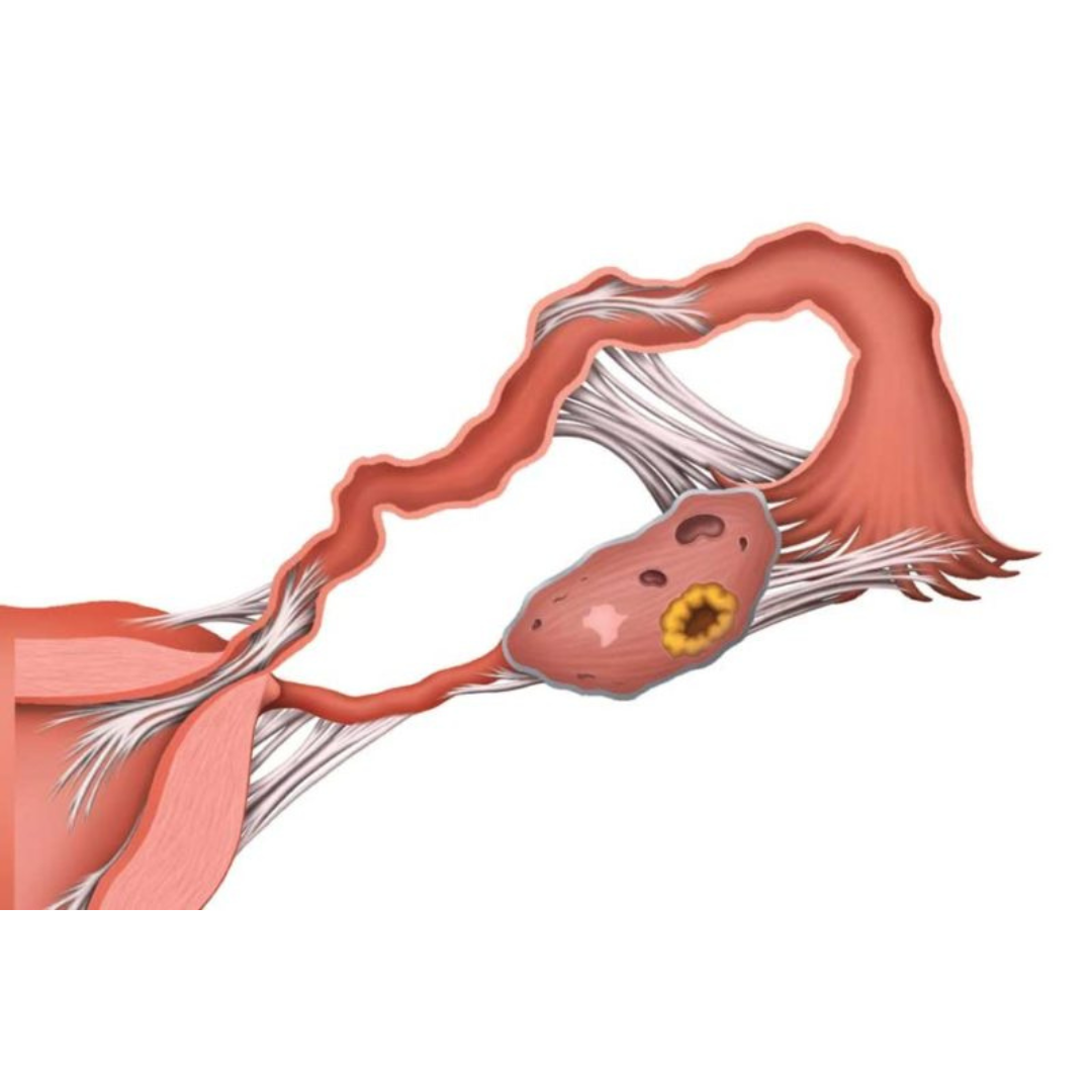 A diagram of adhesions that can cause infertility.