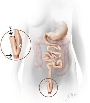 Illustration of an ileal pouch-anal anastomosis (IPAA)