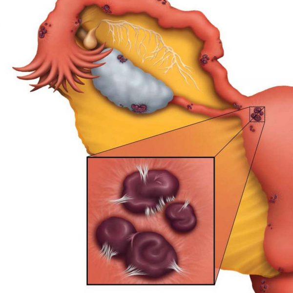 Endometriosis-adhesions-CMYK flat.tif 2